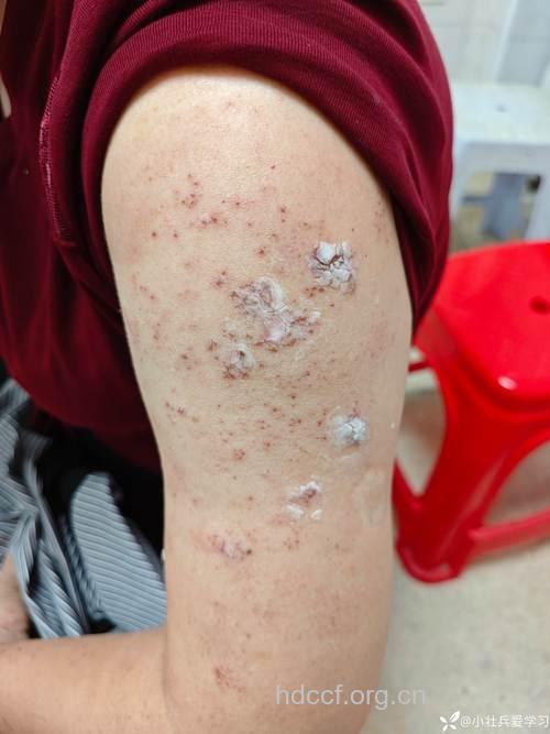 吸烟患者患皮肤癌的几率高