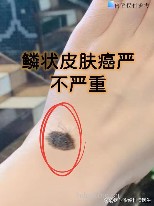 男性皮肤癌经常发现时间较晚