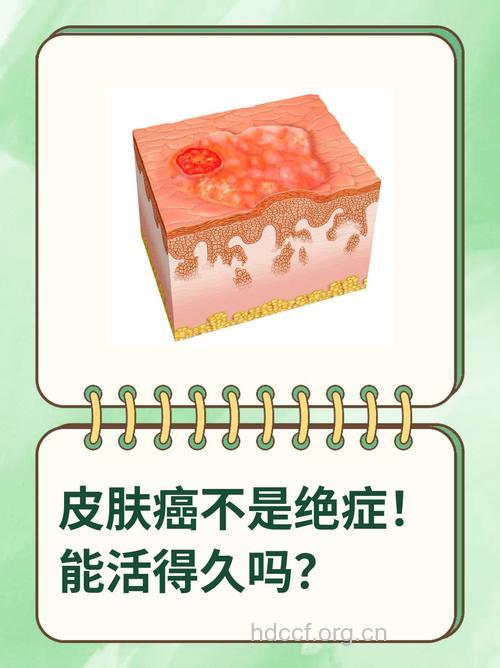 警惕皮肤癌的危险因素