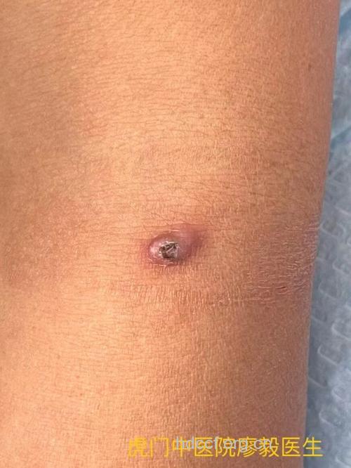 肾移植手术患者应监测皮肤癌