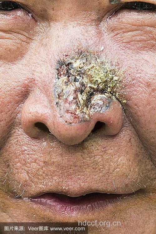 警惕中老年人易患鼻部皮肤癌