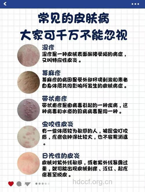 淋雨容易致皮肤癌没有科学依据