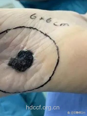 皮肤的隐形杀手--黑色素瘤