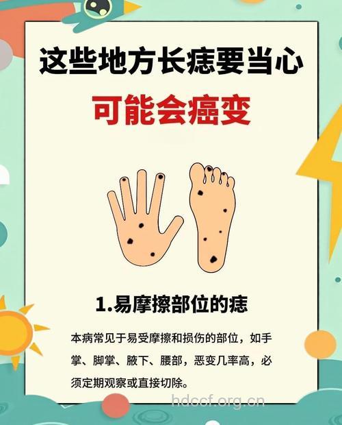 警惕身上的痣千万不要乱点