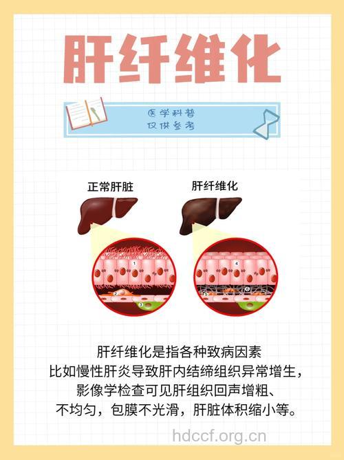疾病百科 肝纤维化是什么呢