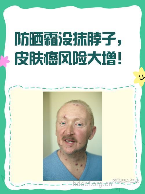 涂抹防晒霜极易诱发皮肤癌