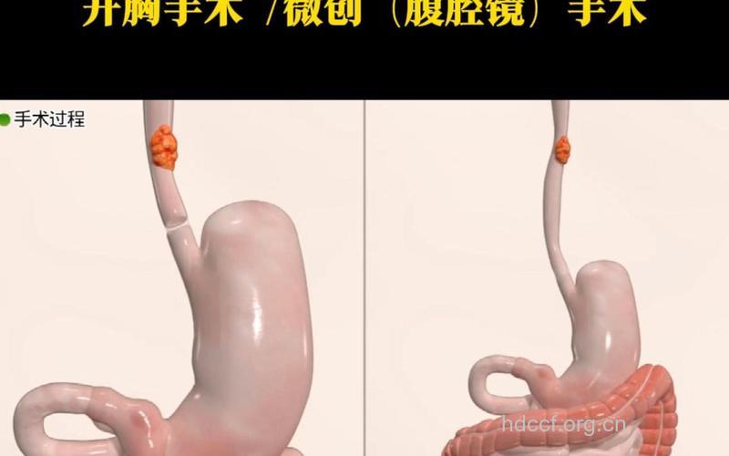 细数食管癌手术治疗方法