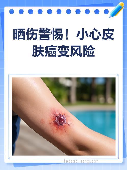 日光晒伤有可能会引起皮肤癌