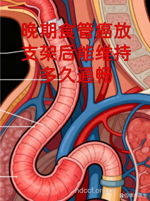 自张型金属支架治食管癌的并发症