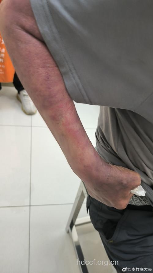 皮肤癌化疗之后的不良反应