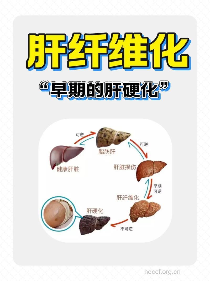 肝纤维化治疗有哪些关键点