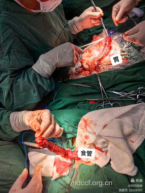 老人慎重选择食道癌手术