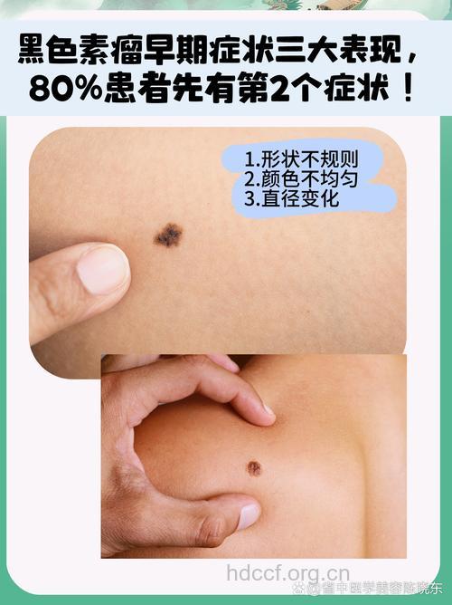 黑色素瘤早期有哪些症状
