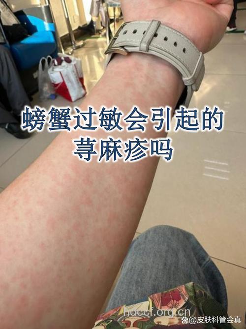 贪吃海鲜当心患上荨麻疹