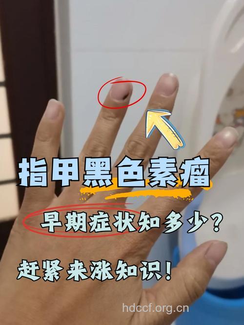 指甲黑色素瘤的治疗方法