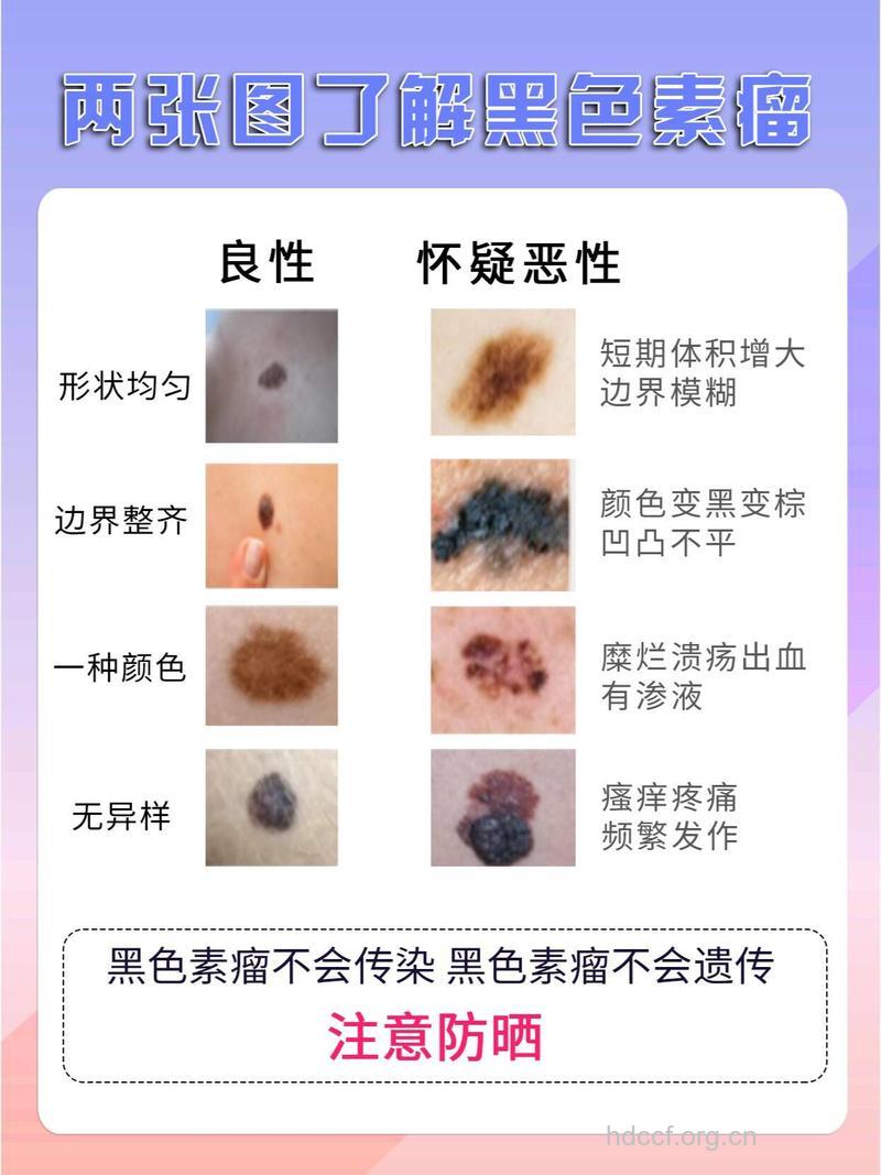 痣与黑色素瘤有什么区别