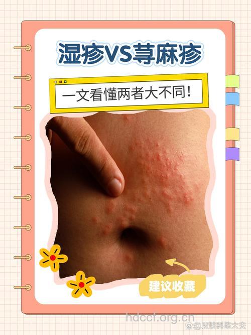 荨麻疹和皮癣有啥区别