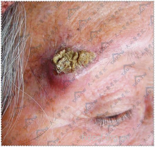 常见的皮肤癌表现有哪些呢