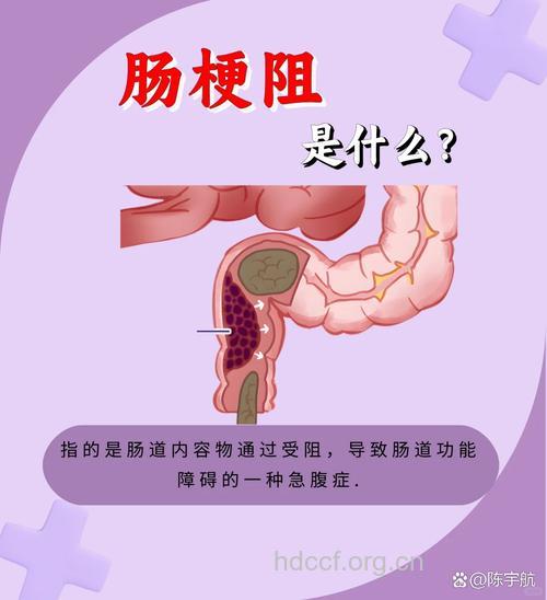 何为肠梗阻
