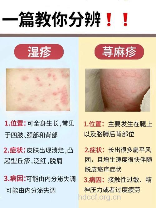 丘疹性荨麻疹和一般荨麻疹有什么区别