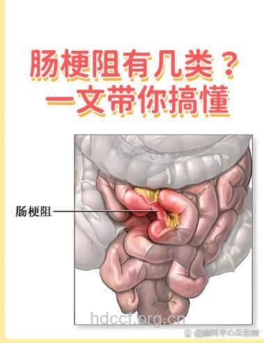 肠梗阻的临床该如何辨别