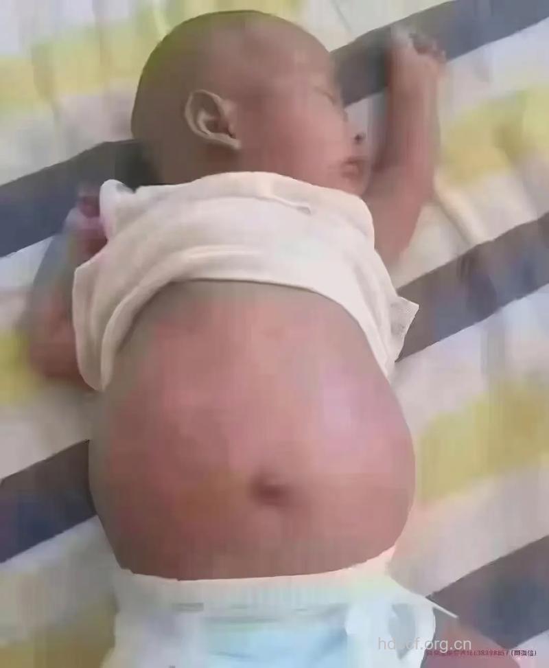 小儿肠梗阻的症状