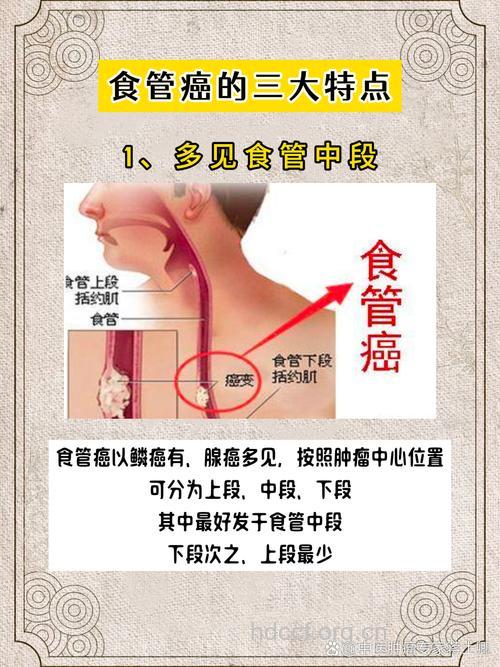 食道癌也会遗传吗？