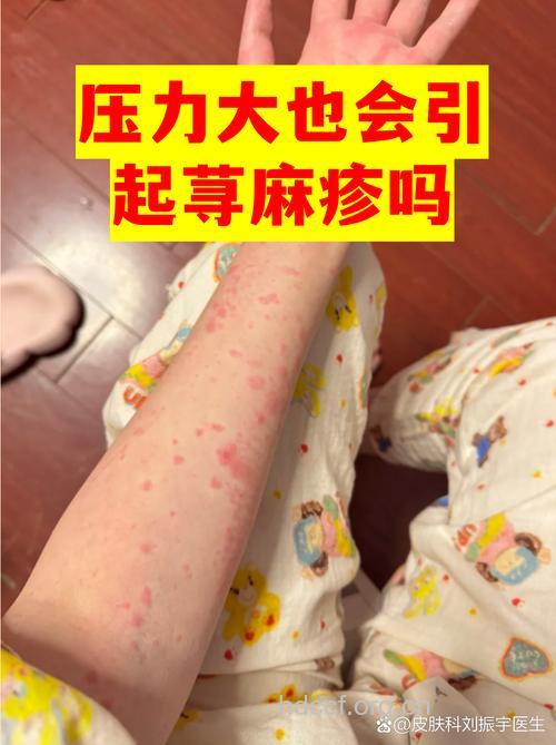 小心!压力过大引起荨麻疹