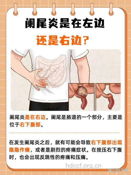 什么是急性阑尾炎