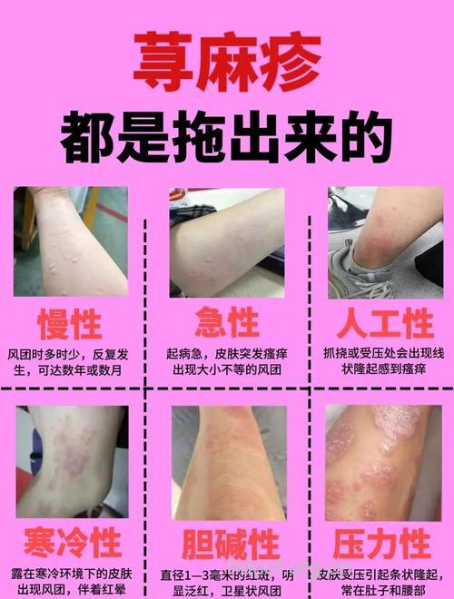 荨麻疹不治疗或致严重后果
