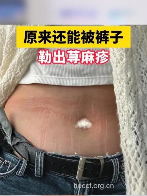 牛仔裤穿太紧容易患荨麻疹