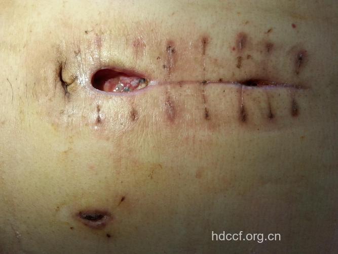 肠梗阻手术后难痊愈