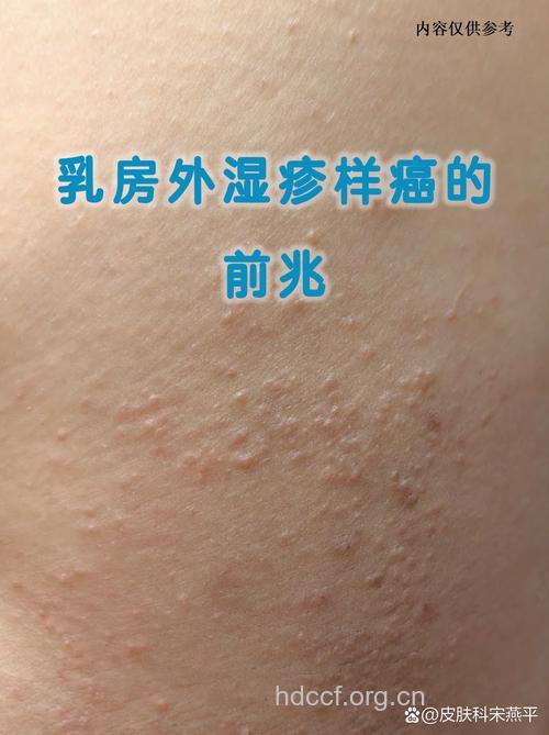 乳房外皮肤湿疹样癌的典型表现