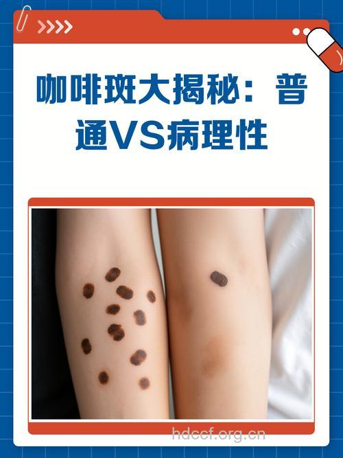 咖啡因具有抗皮肤癌的效果吗