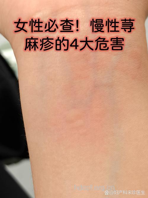 慢性荨麻疹有哪些类型