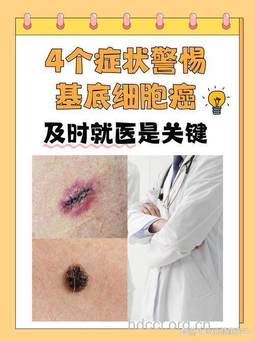 警惕皮肤癌的五大先兆