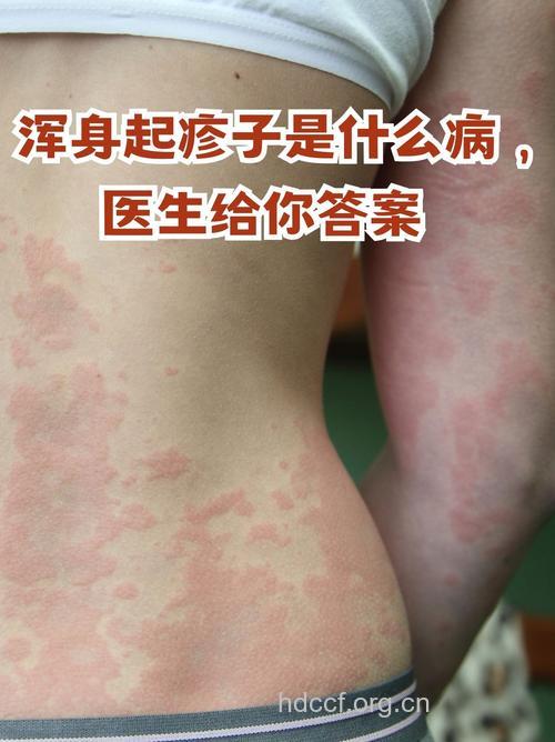 热接触性荨麻疹有哪些临床表现