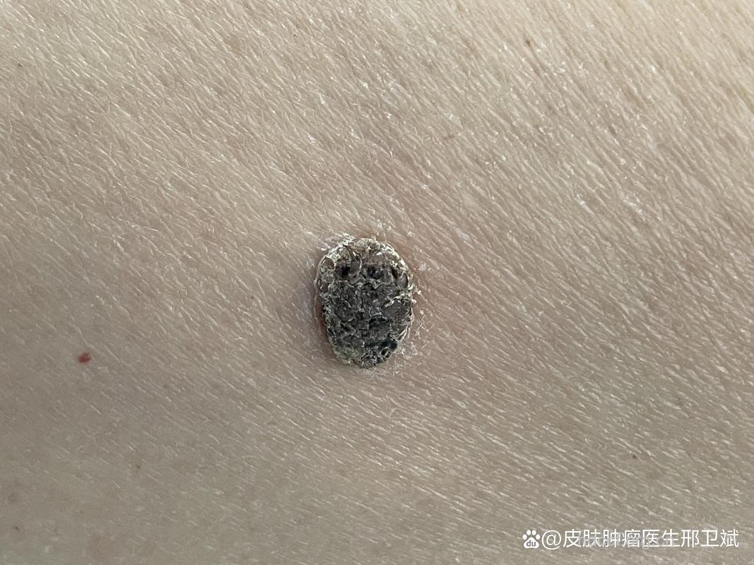 脂溢性角化病症状有哪些