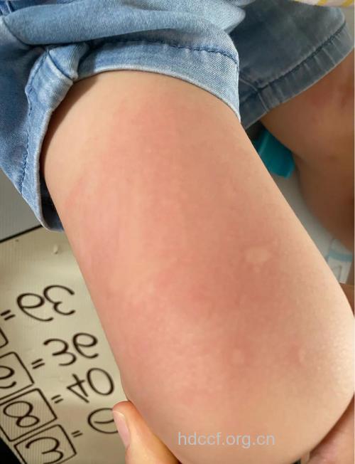 什么是小儿腹型荨麻疹