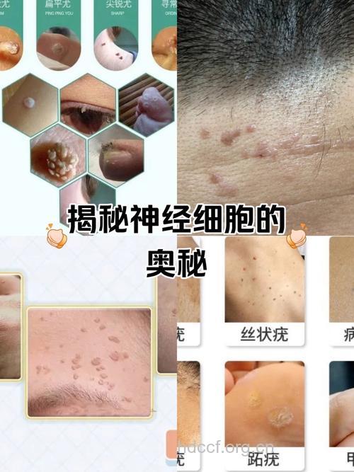 携带变异基因的人会患皮肤癌吗