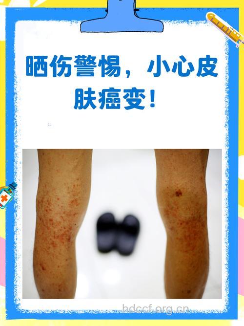 紫外线辐射过多可能导致皮肤癌