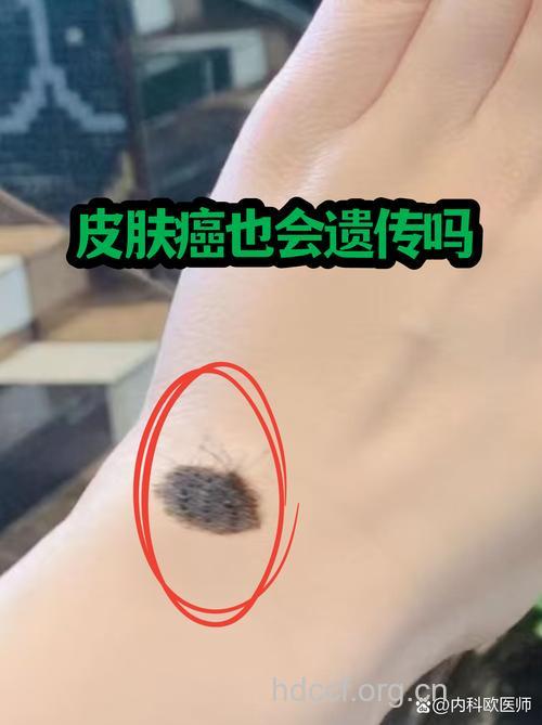 香水会导致皮肤癌吗