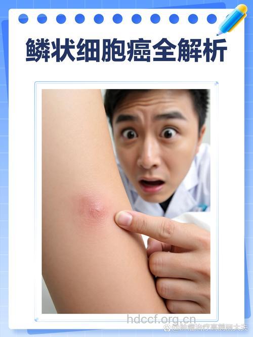 航空人员更易得皮肤癌吗