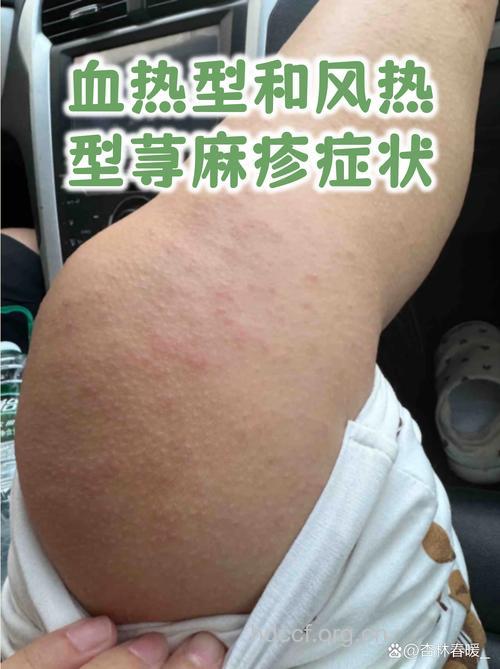 过敏性荨麻疹有哪些表现