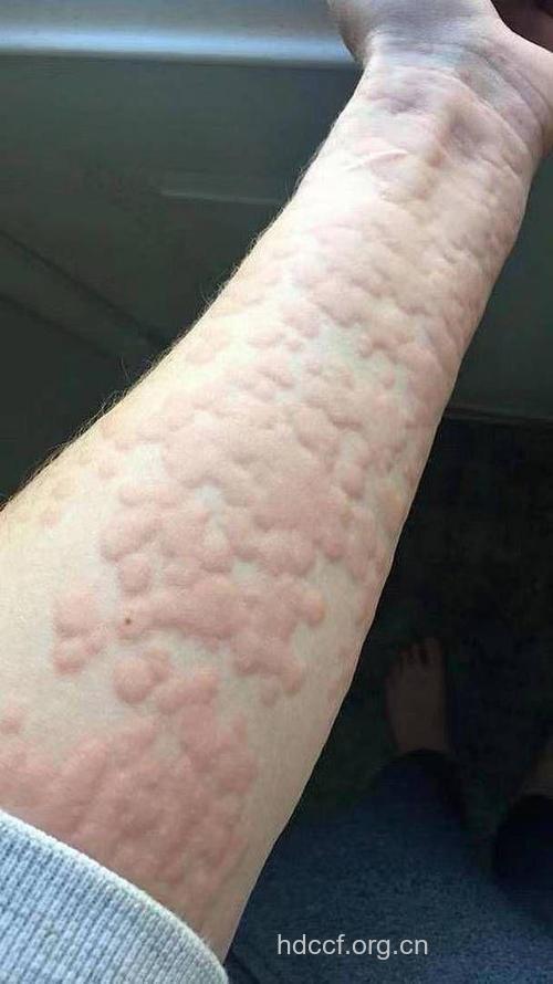 荨麻疹会出现什么症状呢