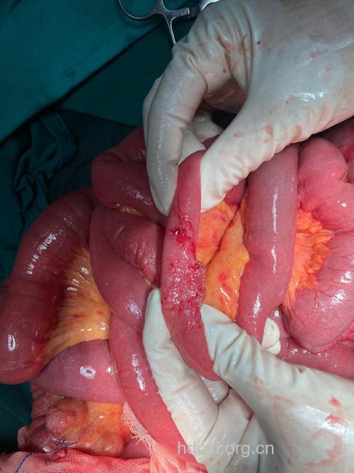 全解肠梗阻的非手术治疗