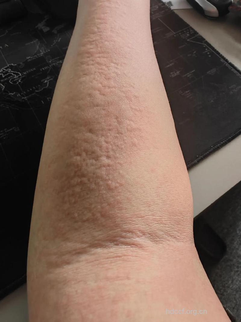 急性荨麻疹有什么症状