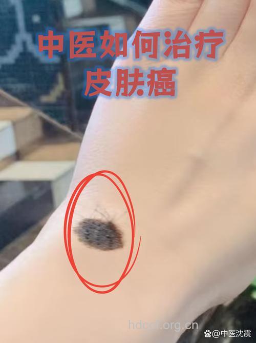 中医是怎么辨别皮肤癌的