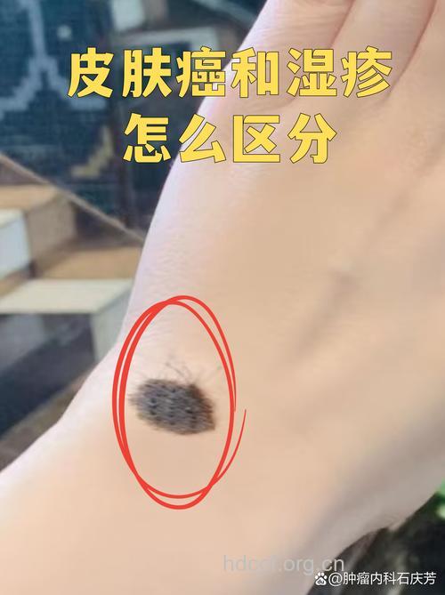 皮肤癌常常会和什么病混淆