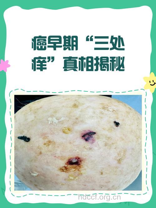 皮肤久痒是肿瘤的警钟